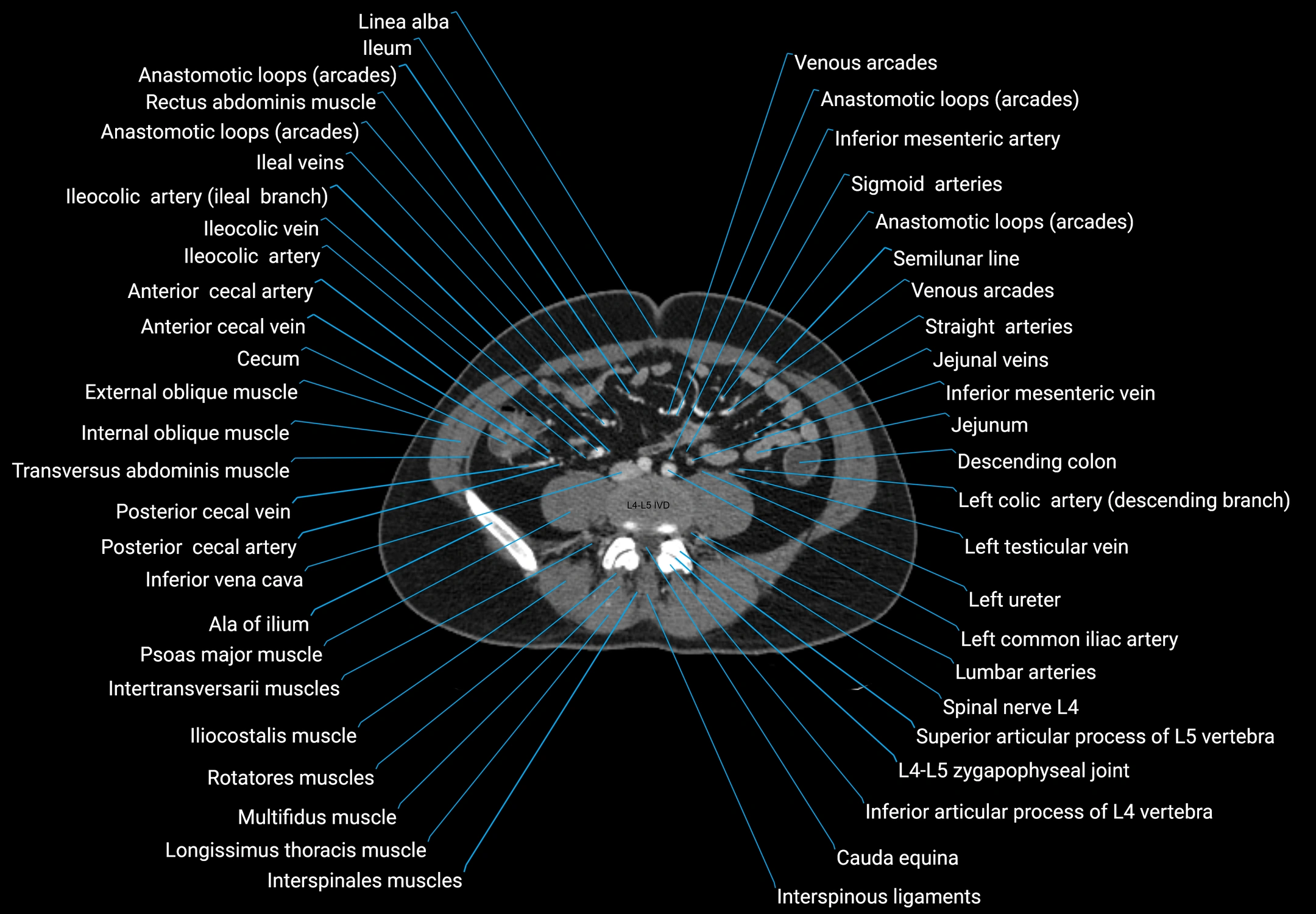 CT male pelvis axial cross sectional anatomy labelled radiology image -00118.webp